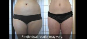 ultraslim-results-charlotte-nc