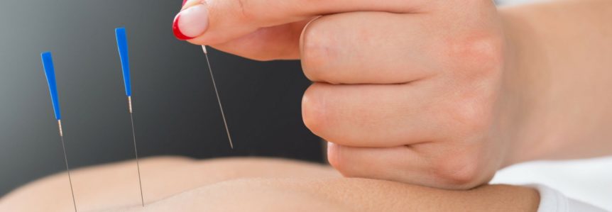 woman receiving acupuncture for natural pain management