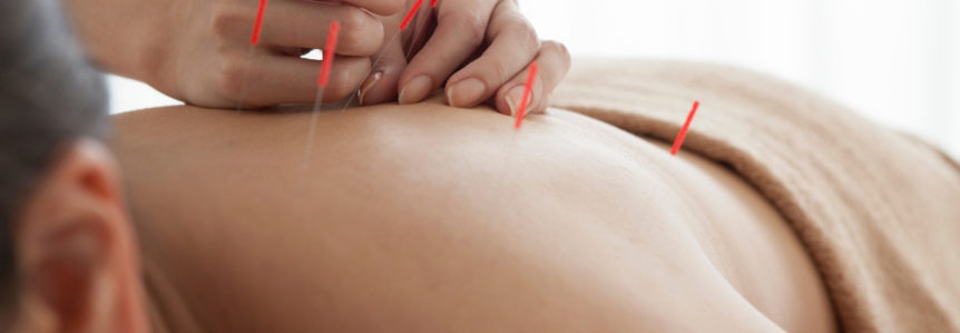 Patient receiving acupuncture on back